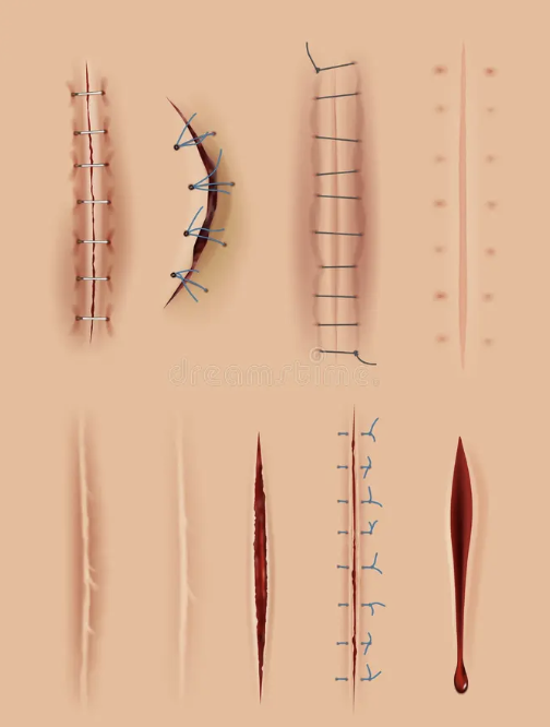 Scar Revision